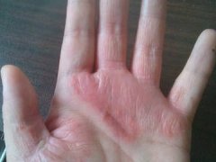 你不知道的引起皮炎的“四大原因”