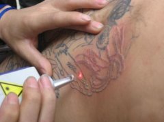 [阳泉纹身医院]一个20岁女孩洗纹身自述