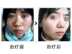 九州治疗雀斑后,还需要哪些皮肤保养方法？
